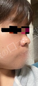 治療直後の症例写真