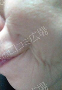 治療直後の症例写真