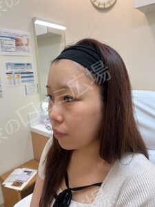 【筒井院長】脱脂術＋ピュアグラフティング　リポキューブの治療前の症例写真