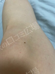 治療前の症例写真