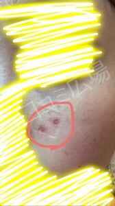 治療直後の症例写真