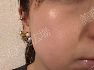 治療直後の症例写真
