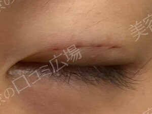 【学生限定】LS法ダブルスタンダードプラン　両目の治療直後の症例写真