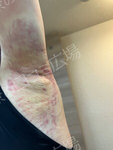 治療直後の症例写真