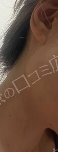 治療結果の症例写真