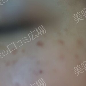 治療直後の症例写真