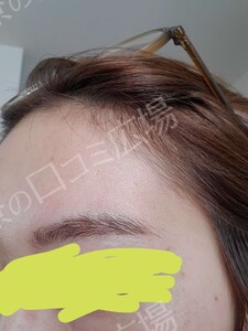 治療結果の症例写真