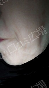 治療直後の症例写真