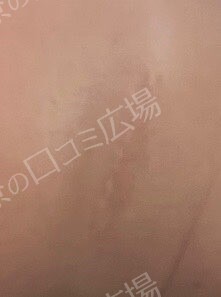 ブリスクリニックの傷跡治療、ケロイドの症例写真[ビフォー]
