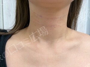 治療直後の症例写真