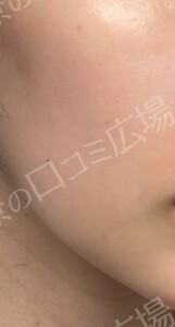フォトフェイシャルStellar M22の治療直後の症例写真