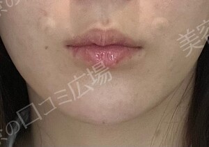 治療直後の症例写真