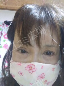治療直後の症例写真