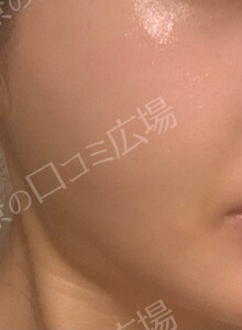 ジェネシスの治療結果の症例写真