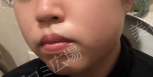 治療前の症例写真