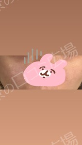 ララドクター｜低刺激ピーリング｜ララピール進化版の治療直後の症例写真