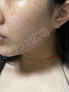 治療直後の症例写真