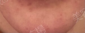 治療直後の症例写真