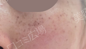 治療直後の症例写真
