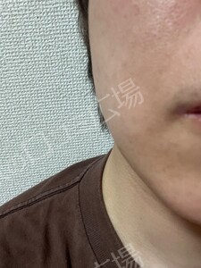 治療直後の症例写真