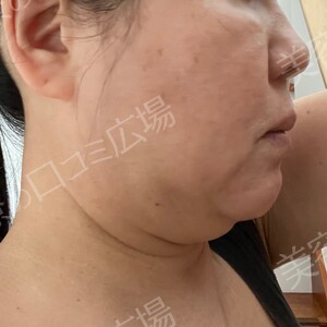 治療直後の症例写真