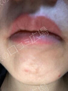 リップ ＆ アイライン上下 アートメイク 2回 モニター施術の治療結果の症例写真
