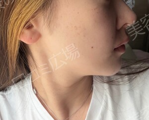 治療直後の症例写真