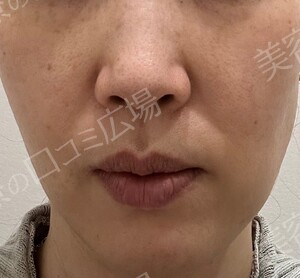 治療直後の症例写真