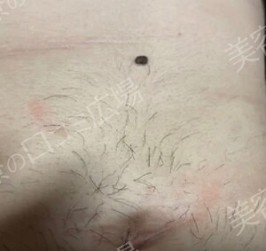 ブリスクリニックのほくろ除去・あざ治療・イボ治療の症例写真[ビフォー]