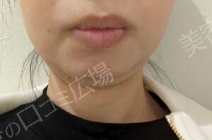 さっぽろ美容クリニック 本院のメディカルダイエット・痩身の症例写真[ビフォー]