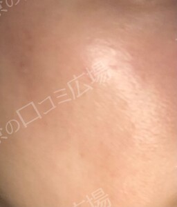 治療直後の症例写真