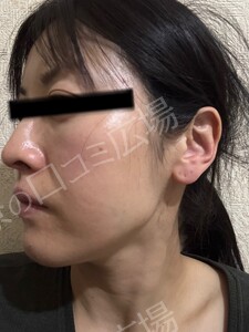 治療結果の症例写真