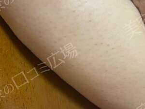 口コミ広場会員様限定！全身脱毛5回コース 146,300円の治療前の症例写真