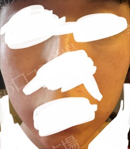 治療前の症例写真