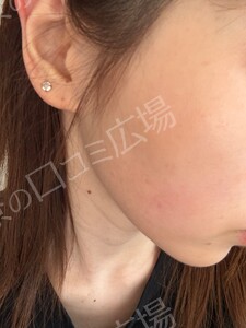 イオン導入｟リピーターOK｠の治療結果の症例写真