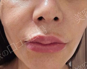 治療直後の症例写真