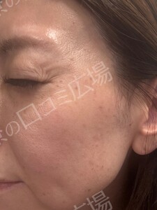 【初回｜平日限定】高出力！ルメッカ2周｜透明感あるお肌に🌿の治療直後の症例写真