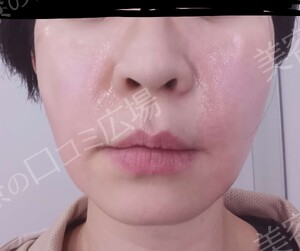 治療直後の症例写真