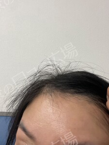 治療直後の症例写真