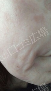 治療直後の症例写真