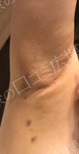 治療直後の症例写真