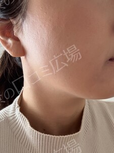 治療結果の症例写真