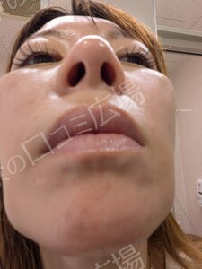 治療直後の症例写真