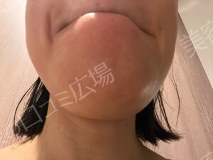 治療直後の症例写真