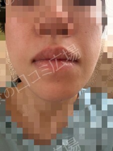 治療結果の症例写真