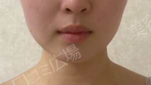 治療直後の症例写真