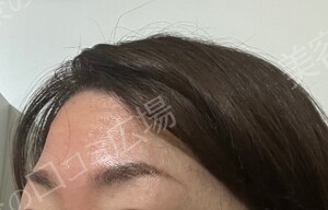 治療直後の症例写真