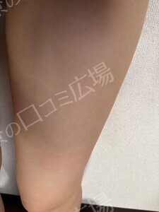治療結果の症例写真