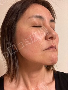 治療直後の症例写真