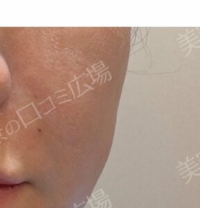 治療直後の症例写真